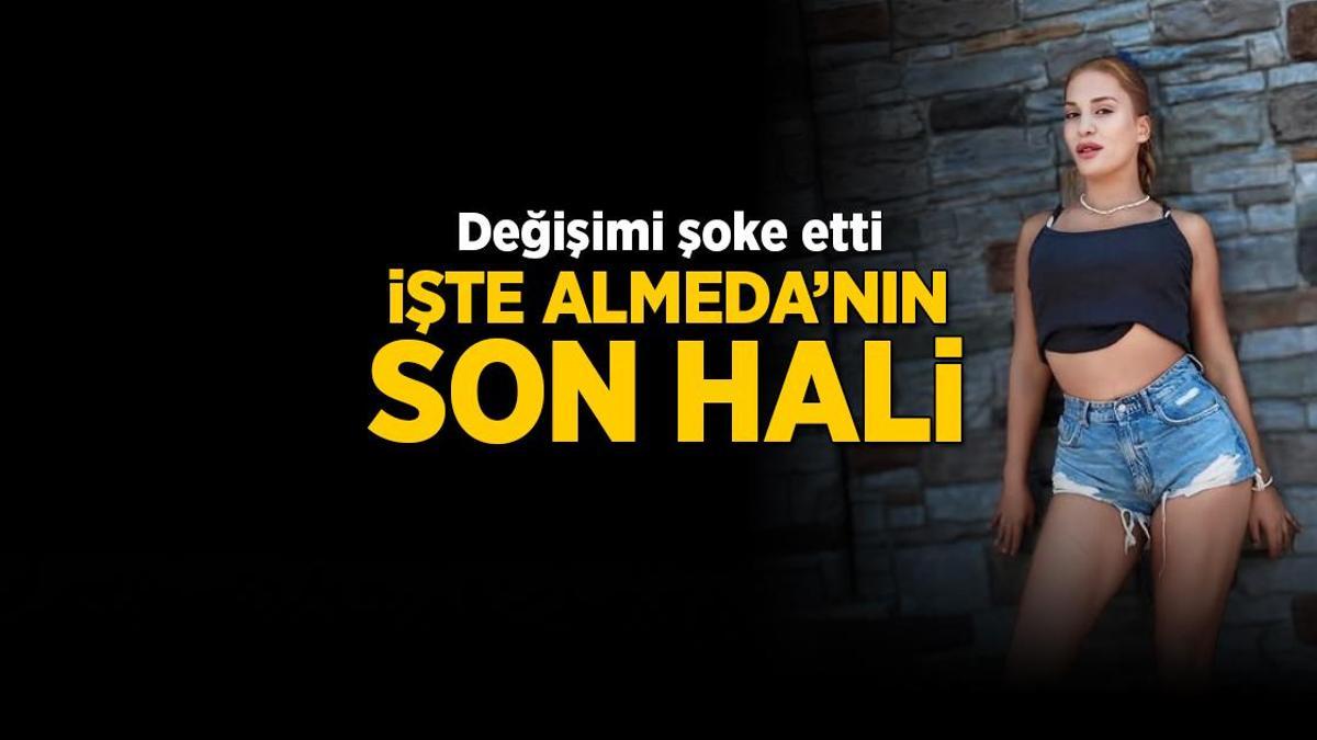 Survivor Almeda burun ameliyatı akabinde son halini paylaştı! Değişimi şoke etti